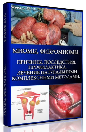 Мини инфопродукт №7. Миомы, Фибромиомы. Причины. П_0.png